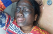 Chhattisgarh AAP leader Soni Sori attacked with acid, hospitalised